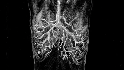 A system of roots burrowing into human lungs